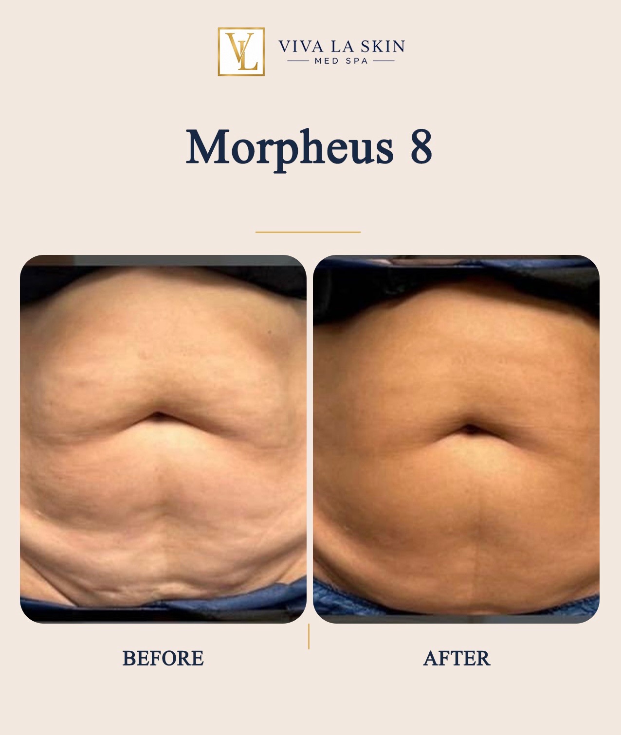 Morpheus8 before and after result at Viva La Skin Med Spa in Myrtle Beach