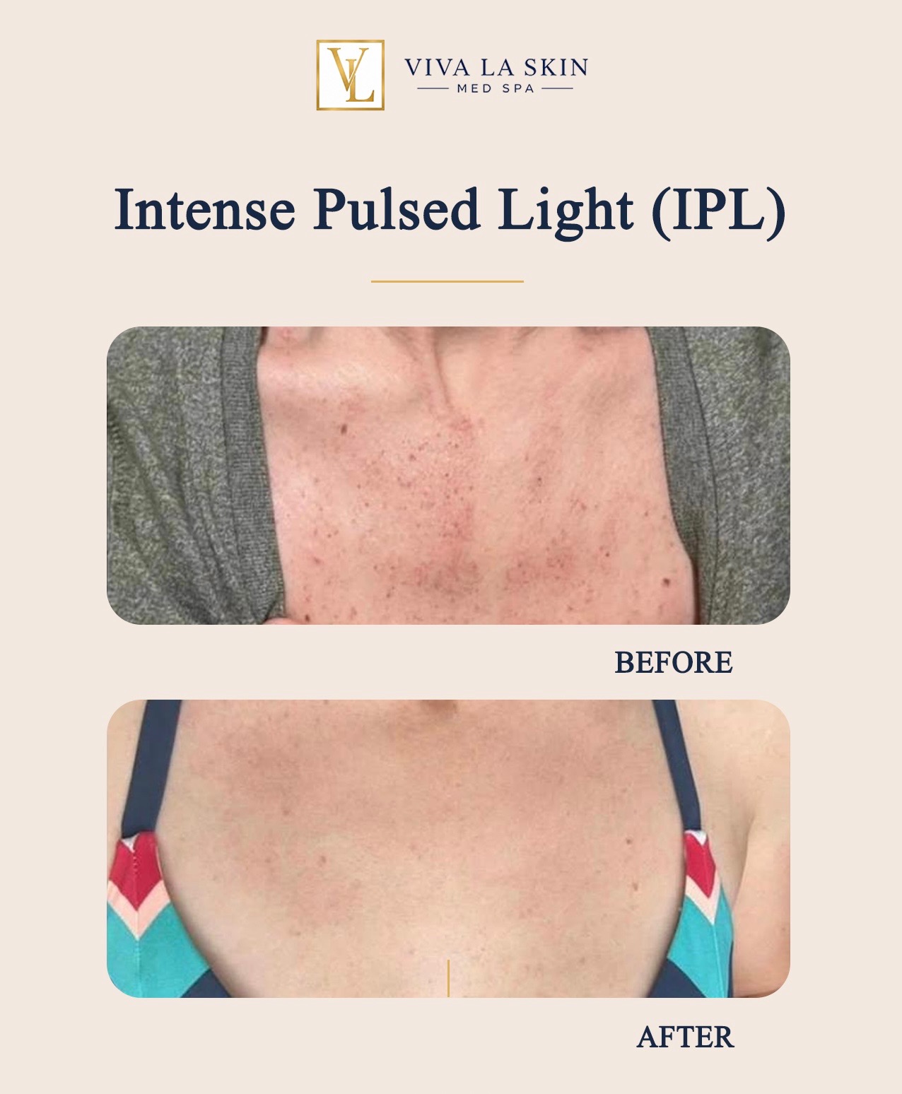 IPL Photofacial before and after result at Viva La Skin Med Spa in Myrtle Beach