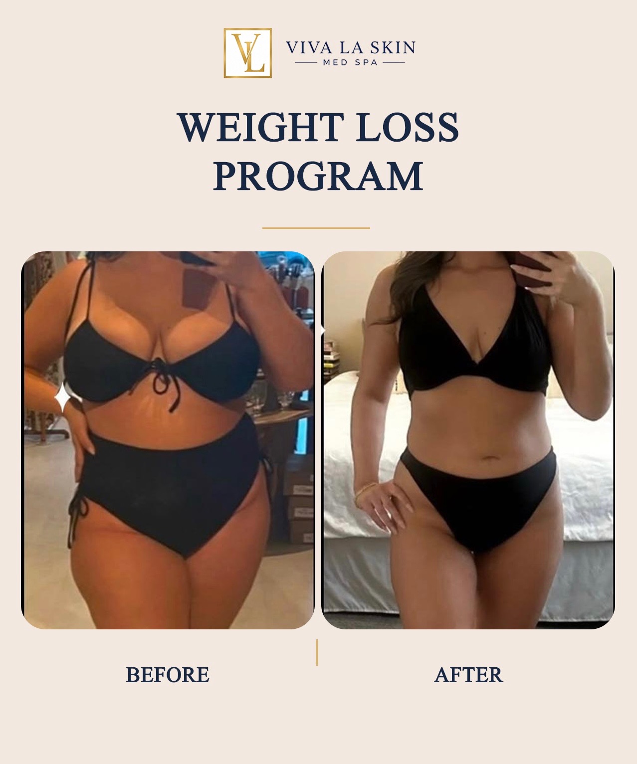 Weight Loss Program before and after result at Viva La Skin Med Spa in Myrtle Beach