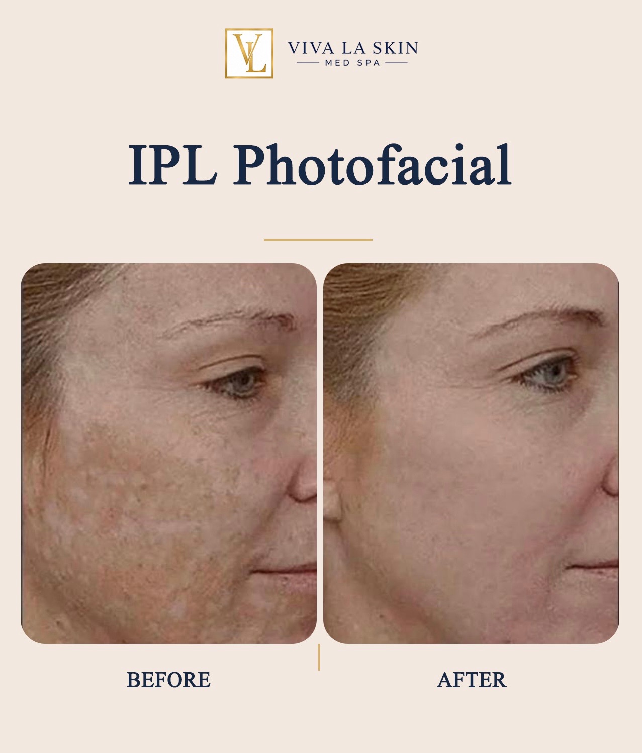 IPL Photofacial before and after result at Viva La Skin Med Spa in Myrtle Beach