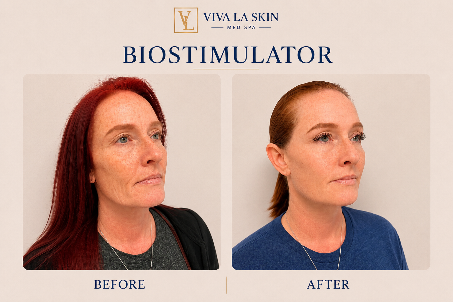 BioStimulator before and after result at Viva La Skin Med Spa in Myrtle Beach