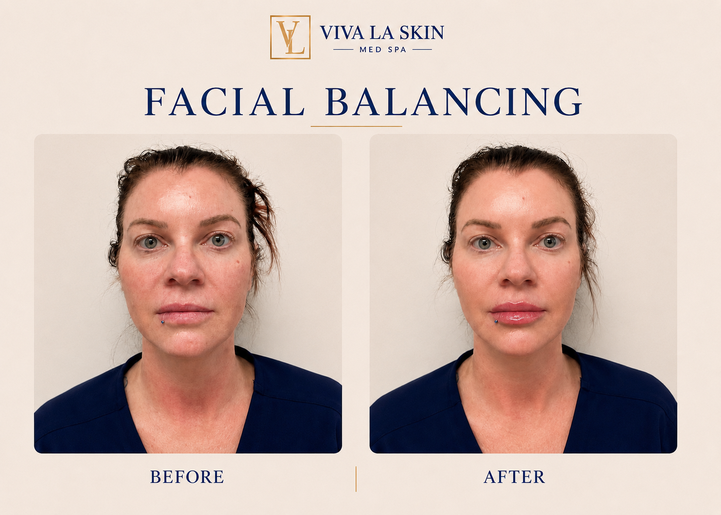 Facial Balancing before and after result at Viva La Skin Med Spa in Myrtle Beach