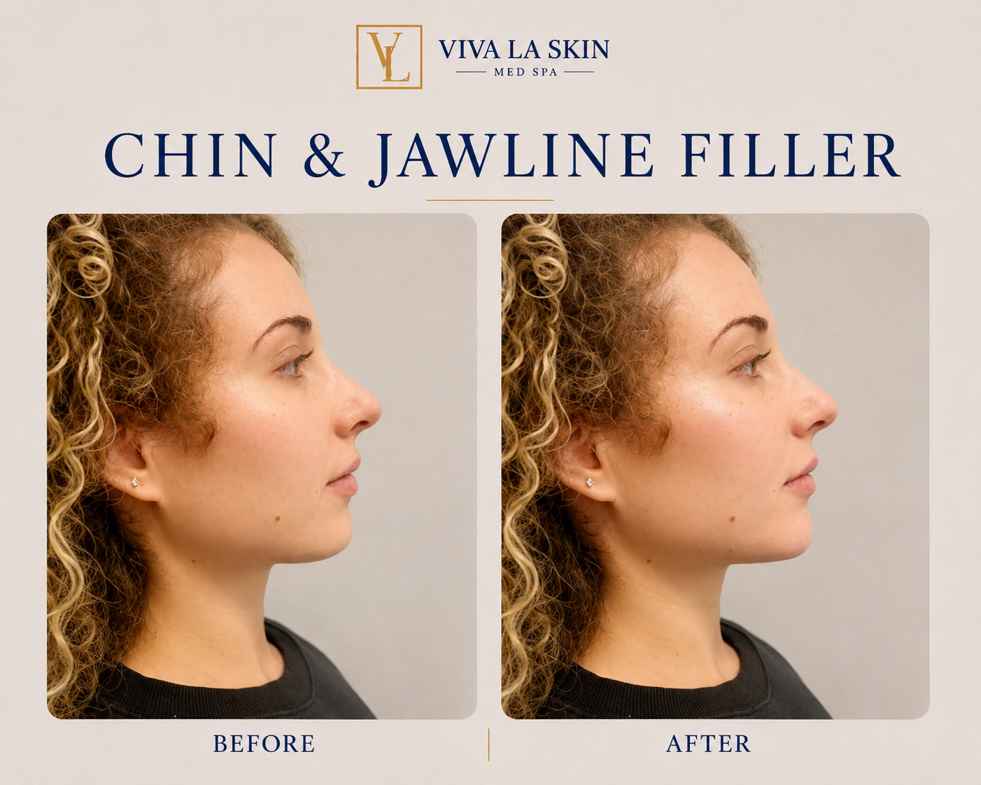 Filler before and after result at Viva La Skin Med Spa in Myrtle Beach