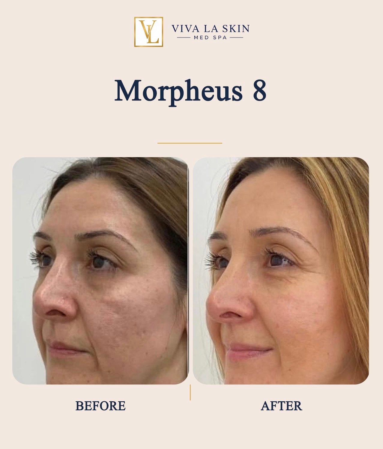 Morpheus8 before and after result at Viva La Skin Med Spa in Myrtle Beach