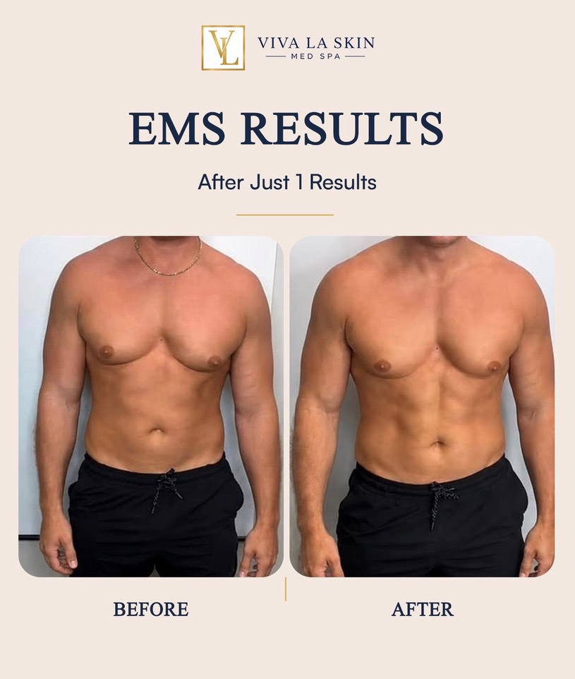 EMS before and after result at Viva La Skin Med Spa in Myrtle Beach