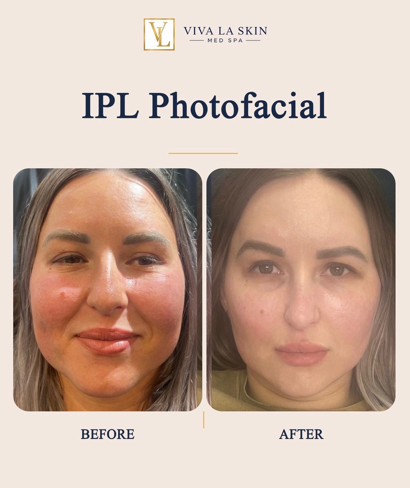 IPL Photofacial before and after result at Viva La Skin Med Spa in Myrtle Beach