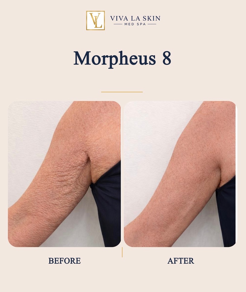 Morpheus8 before and after result at Viva La Skin Med Spa in Myrtle Beach