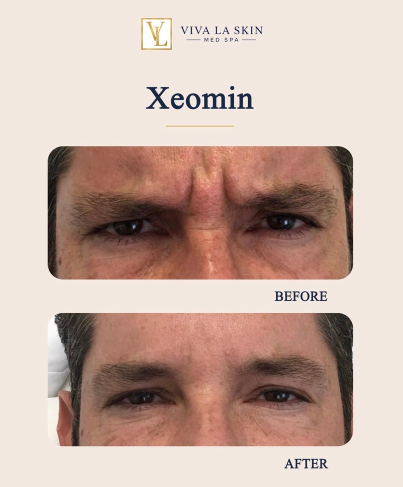 Xeomin before and after result at Viva La Skin Med Spa in Myrtle Beach