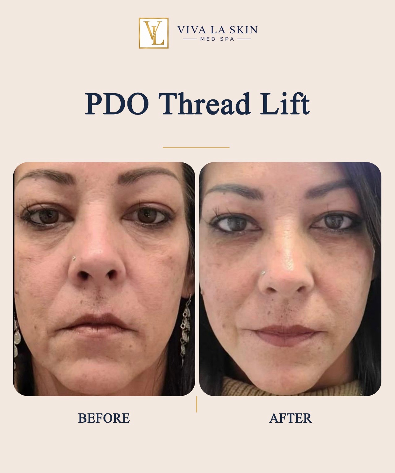 PDO Thread Lift before and after result at Viva La Skin Med Spa in Myrtle Beach