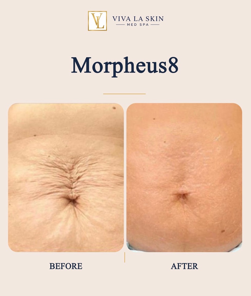 Morpheus8 before and after result at Viva La Skin Med Spa in Myrtle Beach