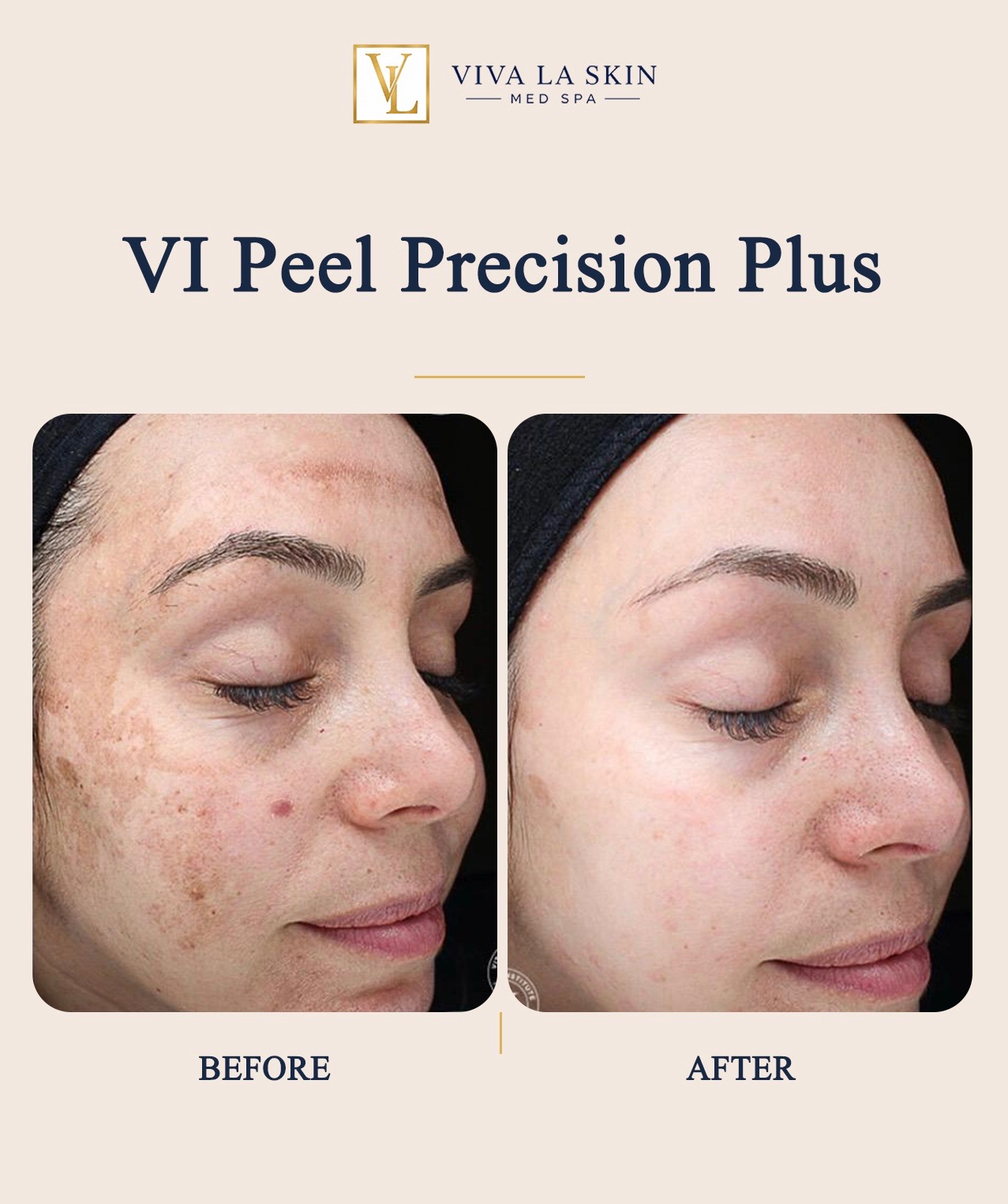 VI Peel Precision Plus before and after result at Viva La Skin Med Spa in Myrtle Beach