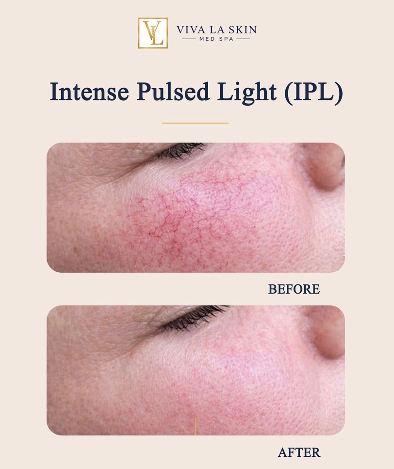 Intense Pulsed Light before and after result at Viva La Skin Med Spa in Myrtle Beach