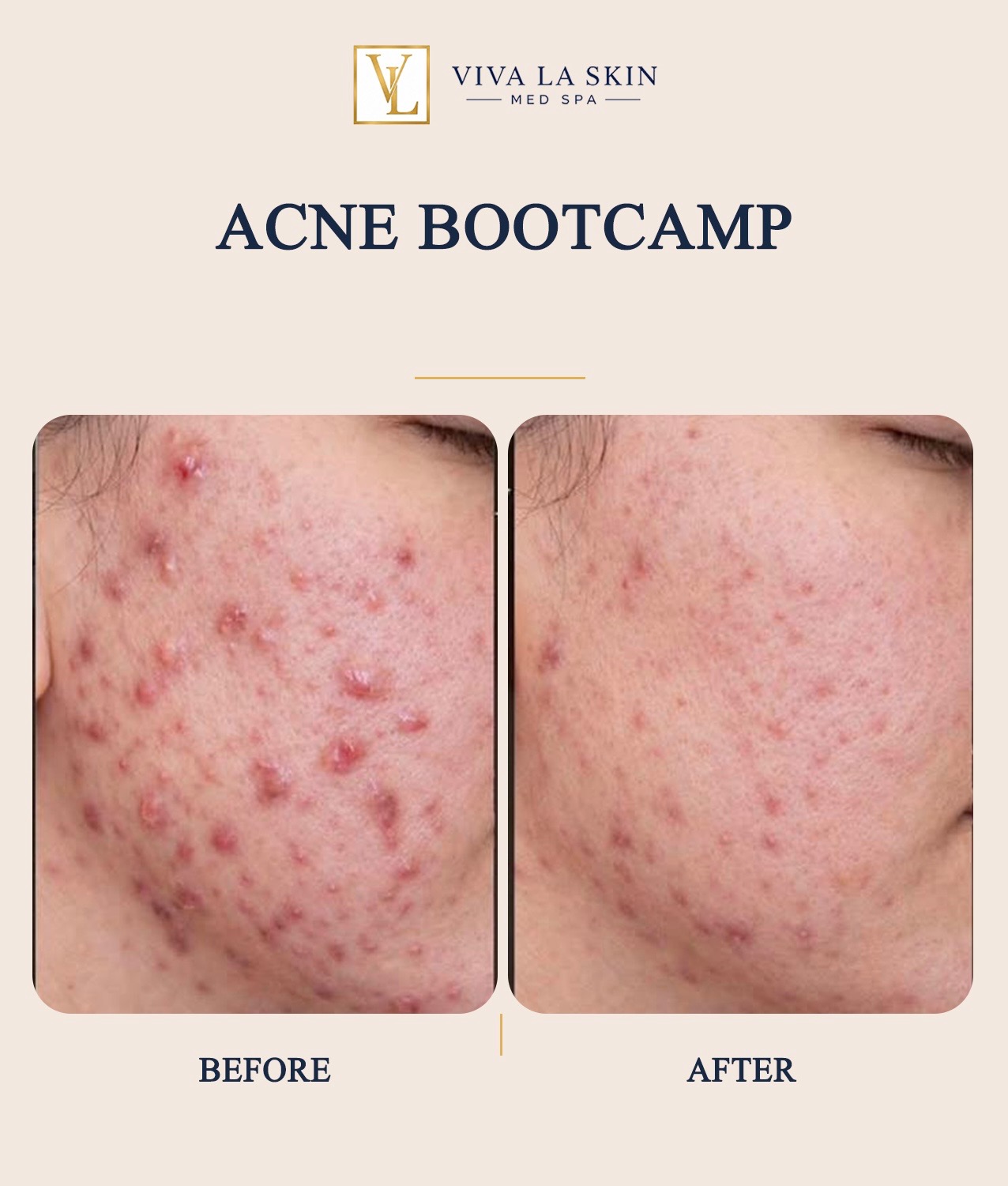 Acne Bootcamp before and after result at Viva La Skin Med Spa in Myrtle Beach