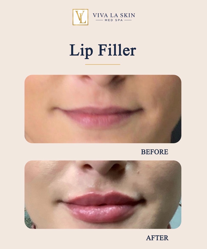 Lip Filler before and after result at Viva La Skin Med Spa in Myrtle Beach