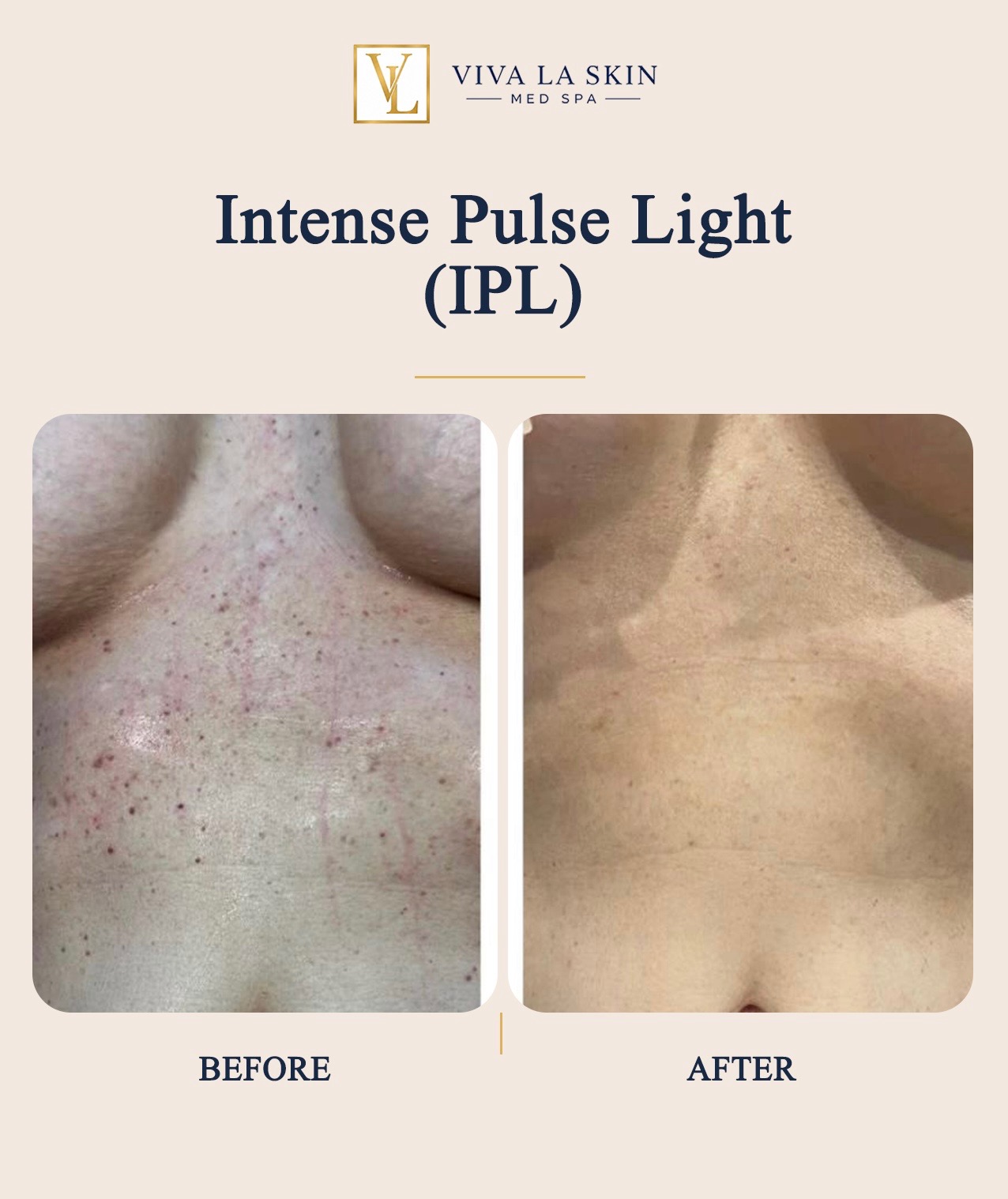 Intense Pulsed Light before and after result at Viva La Skin Med Spa in Myrtle Beach
