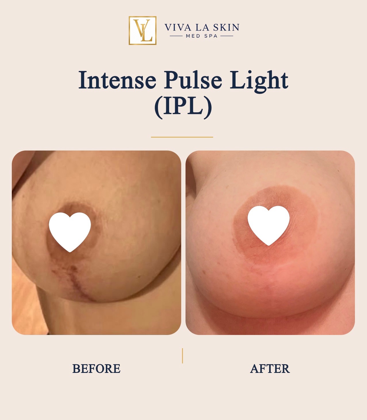 Intense Pulsed Light before and after result at Viva La Skin Med Spa in Myrtle Beach