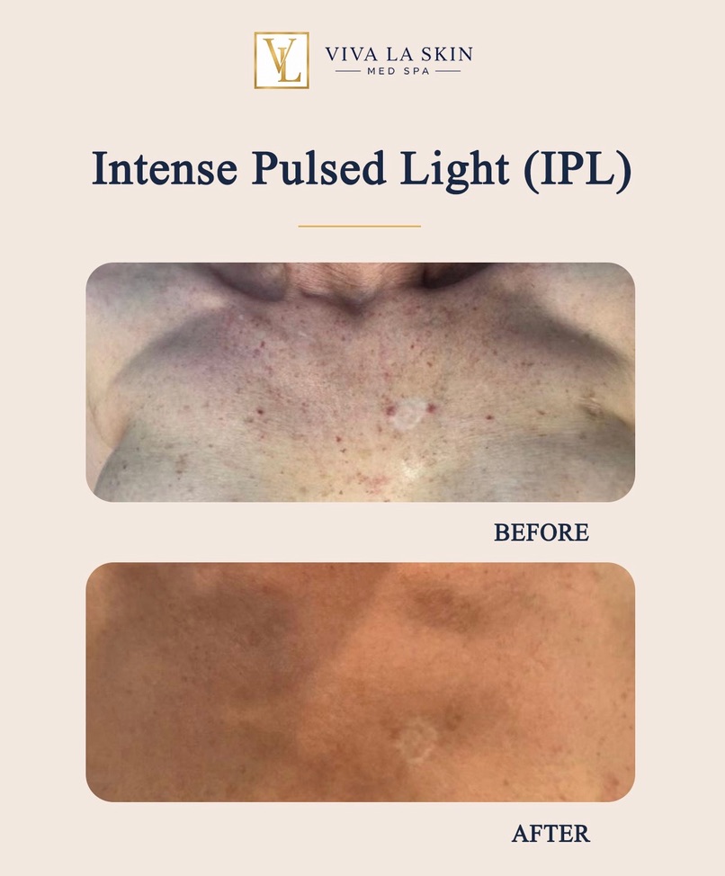 Intense Pulsed Light before and after result at Viva La Skin Med Spa in Myrtle Beach