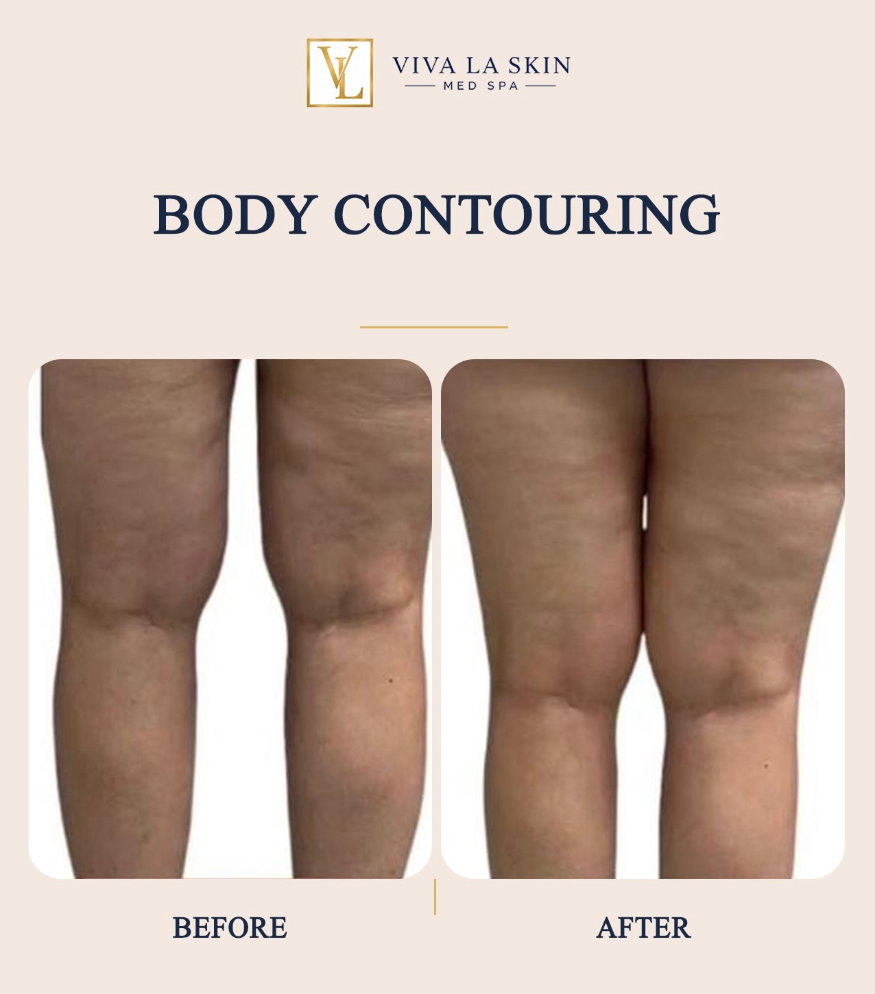 Body Contouring before and after result at Viva La Skin Med Spa in Myrtle Beach
