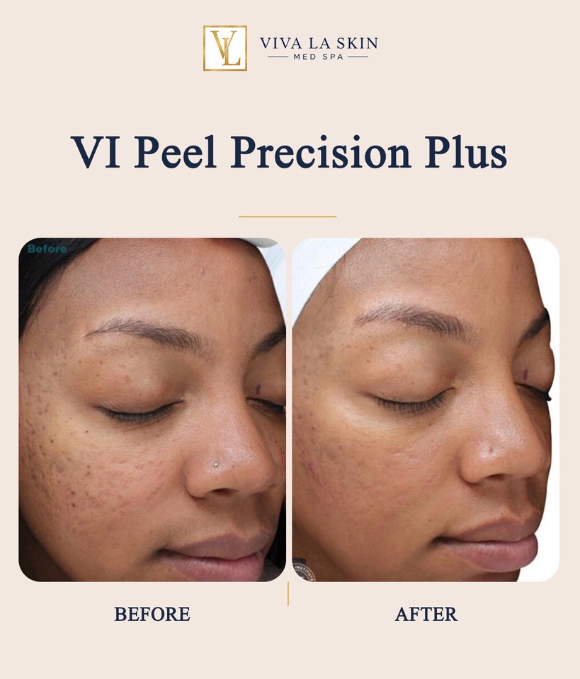 VI Peel Precision Plus before and after result at Viva La Skin Med Spa in Myrtle Beach