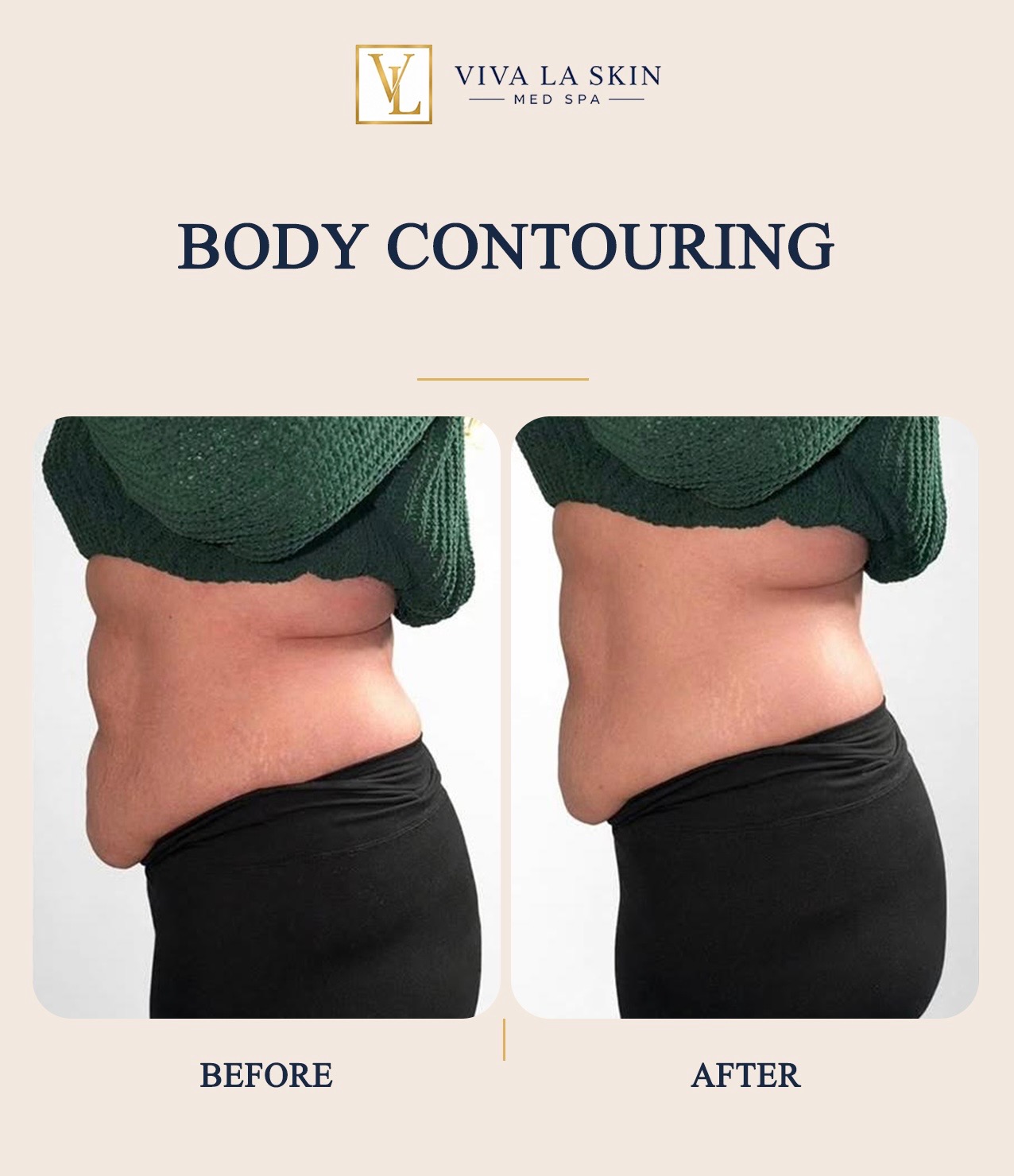 Body Contouring before and after result at Viva La Skin Med Spa in Myrtle Beach